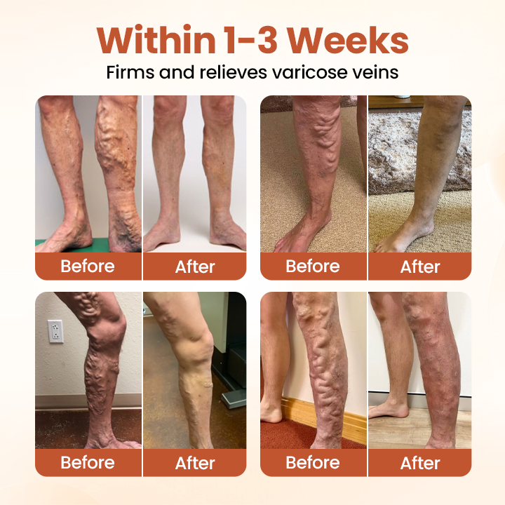 Timilk® VeinTarget Microneedle Patch
