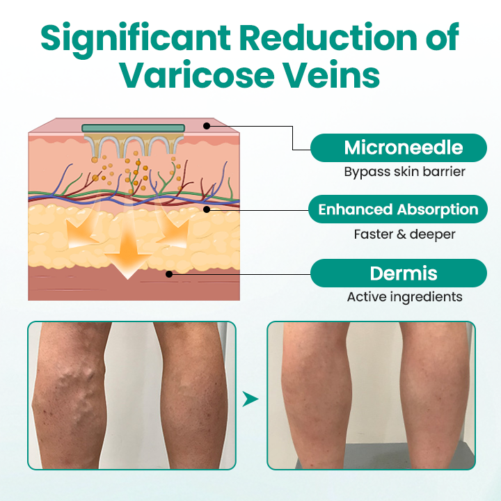 Timilk® LegRenew Varicose Veins Patch(A)