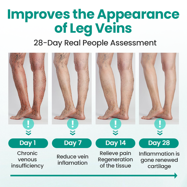Timilk® LegRenew Varicose Veins Patch(A)