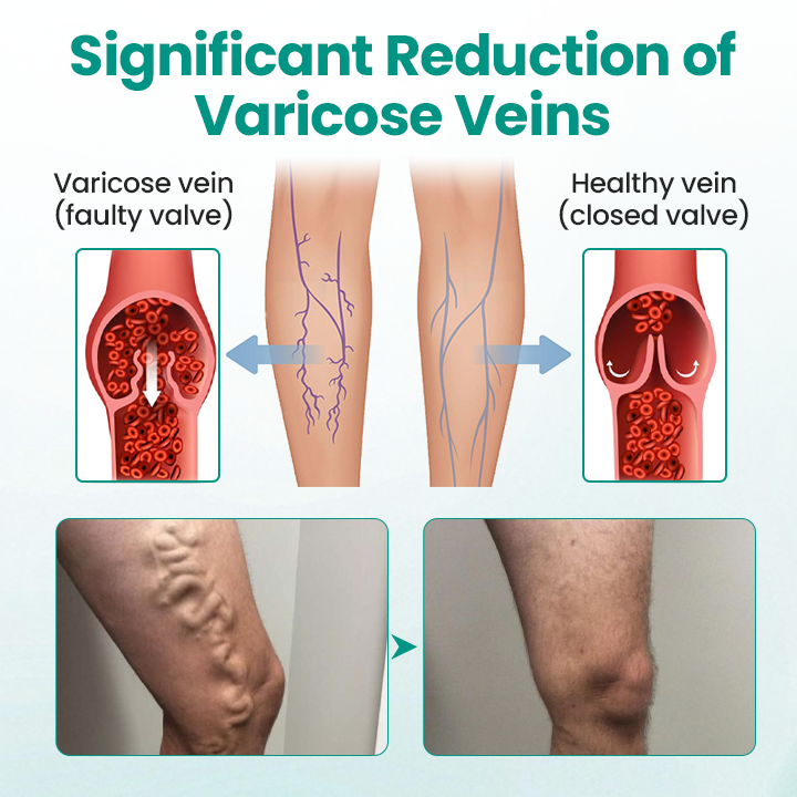 Timilk® LegRenew Varicose Veins Patch(A)