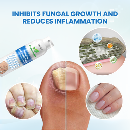 Timilk® PsoriaHeal Herbal Magnesium Soothing Spray (A)