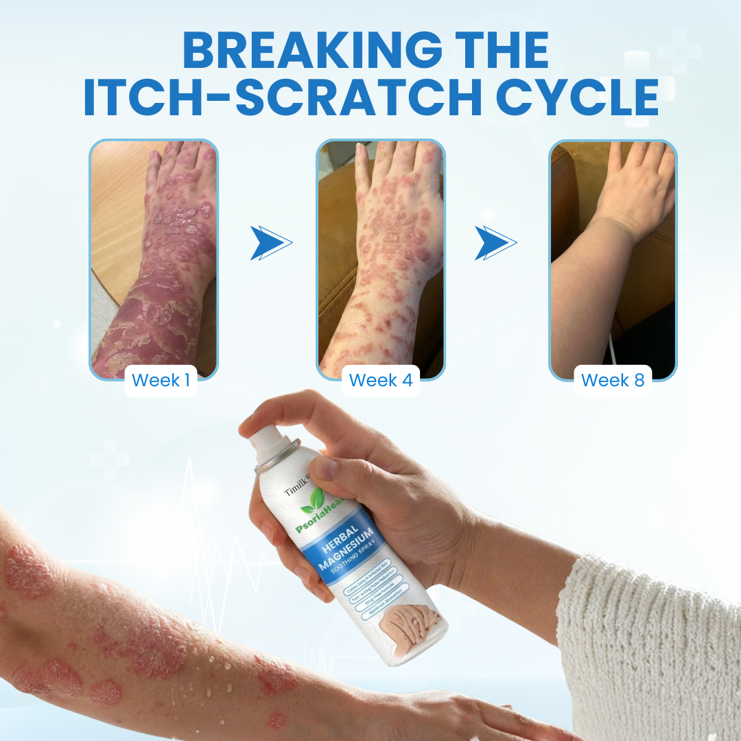 Timilk® PsoriaHeal Herbal Magnesium Soothing Spray (A)