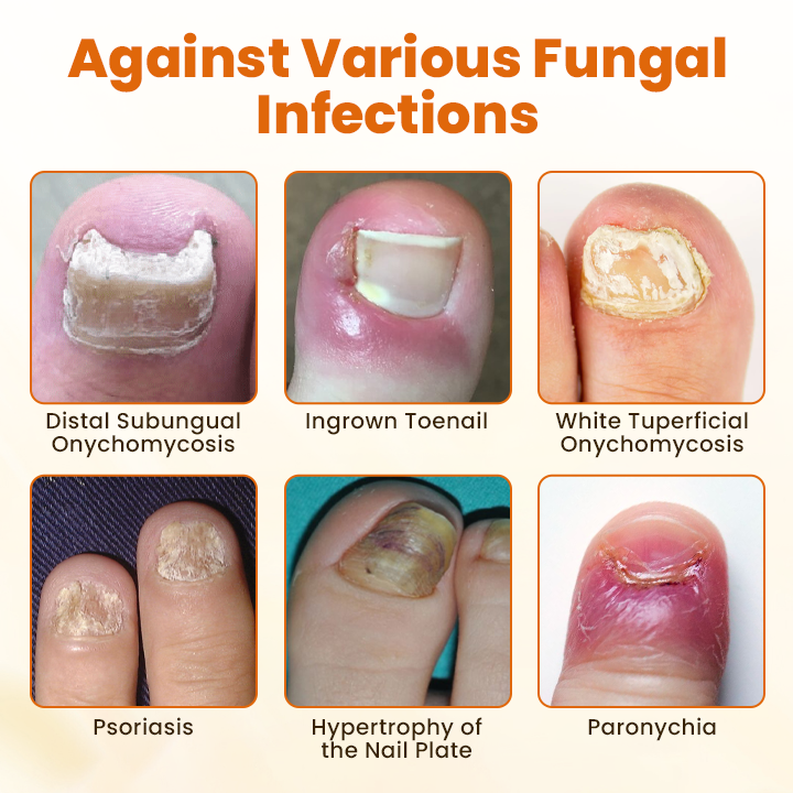 Timilk® FungiBee Advanced Nail Repair Spray (A)