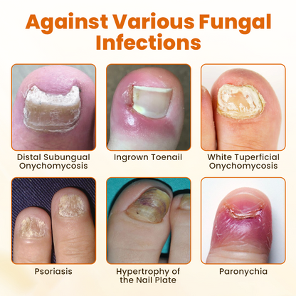 Timilk® FungiBee Advanced Nail Repair Spray (A)