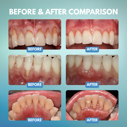 Timilk® GumRescue Precision Gel for Loose Teeth & Bleeding Gums