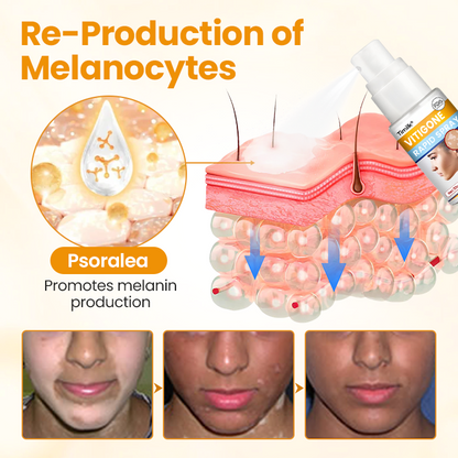 Timilk® VitiGone Rapid Spray — 2–3 Week Repigmentation with OTDS