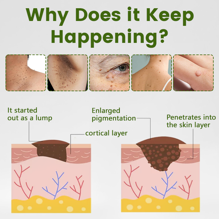 Timilk® ThujaClear Botanical Wart Cream (A)