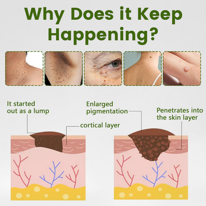 Timilk® ThujaClear Botanical Wart Cream (A)