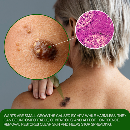 Timilk® ClinixClear Wart Remover Patch (A)