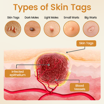 Timilk® BeeVenom Wart Renewal Spray (A)