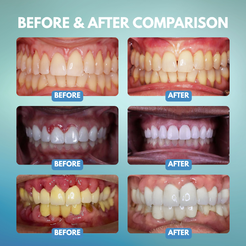 Timilk® GumRescue Precision Gel for Loose Teeth & Bleeding Gums