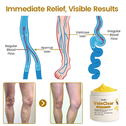 Timilk® VeinClear Bee Venom Cream |✨ Visible Relief in Just 7 Days! 🦵🌿