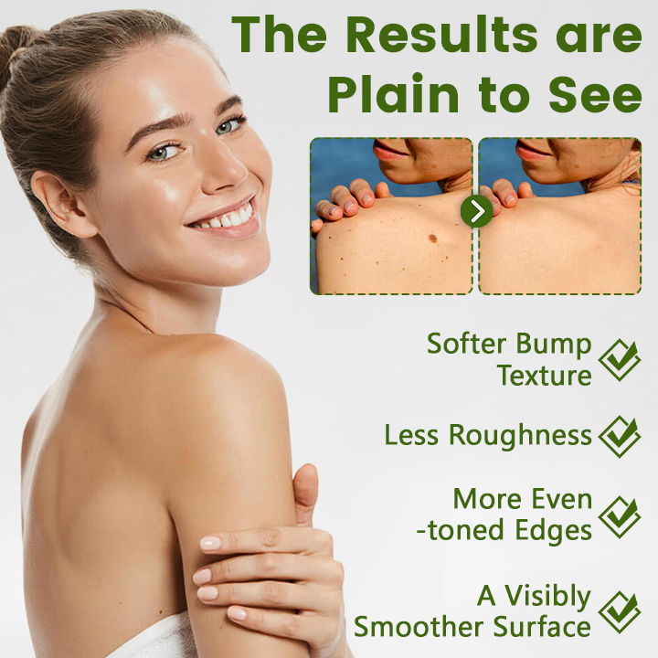 Timilk® ThujaClear Botanical Wart Cream (A)