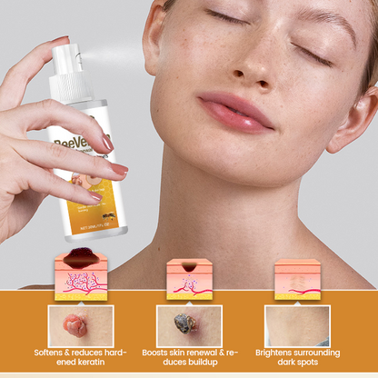 Timilk® BeeVenom Wart Renewal Spray (A)