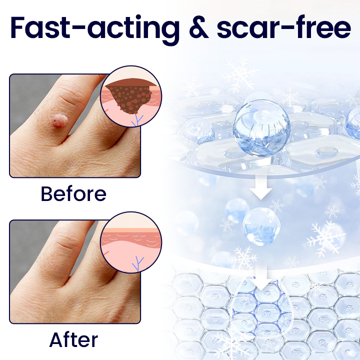 Timilk® WartErase Cryo Freeze Spray (A)