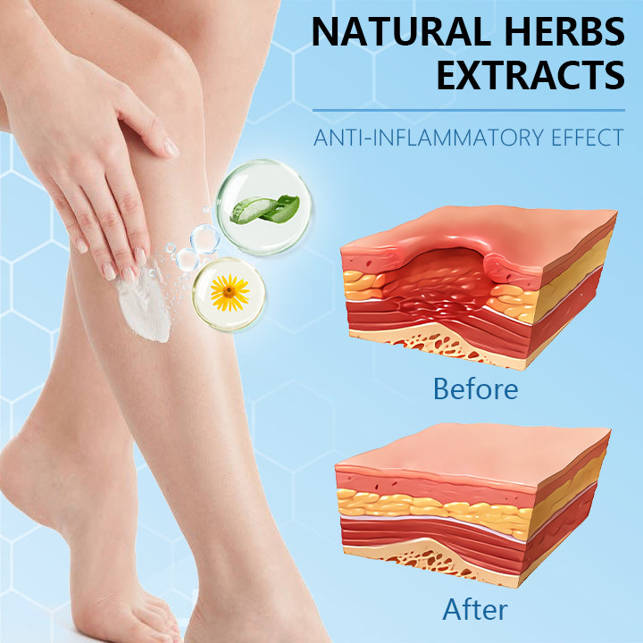 Ceoerty™ Varicose Veins Cream with Hydrogel（A)