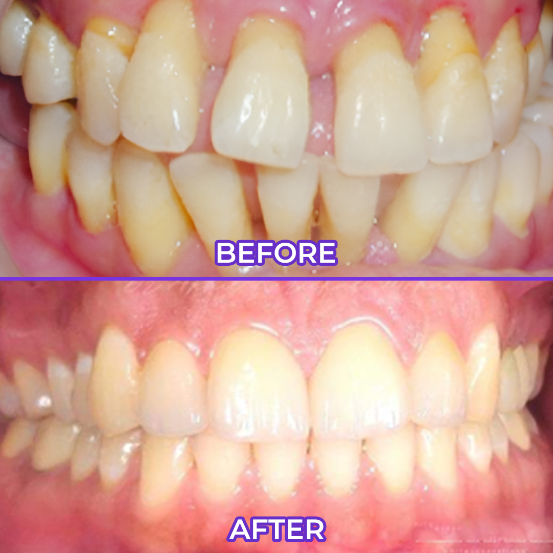 Biancat® SensiGum Fluoride Toothpaste（A）
