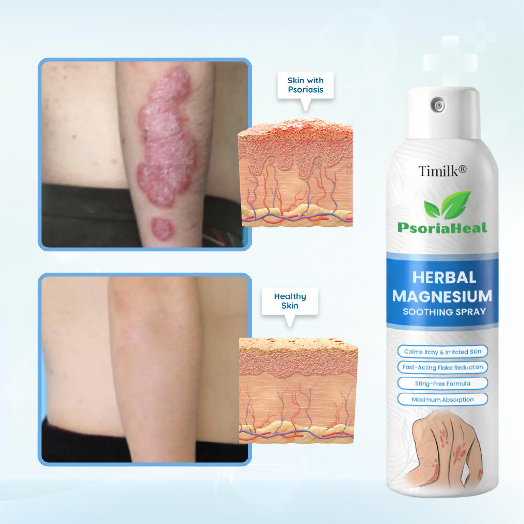 Timilk® PsoriaHeal Herbal Magnesium Soothing Spray (A)